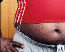 Obesity Increasing in Africa, 672m People Affected Globally